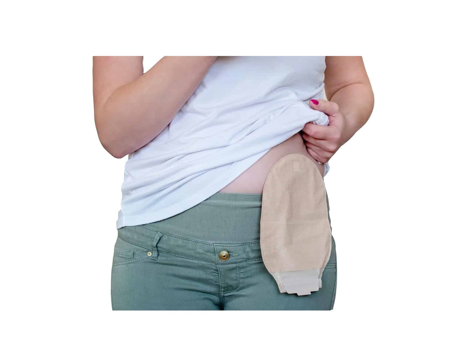 Poche d’iléostomie Alterna ( Système 1 pièce )