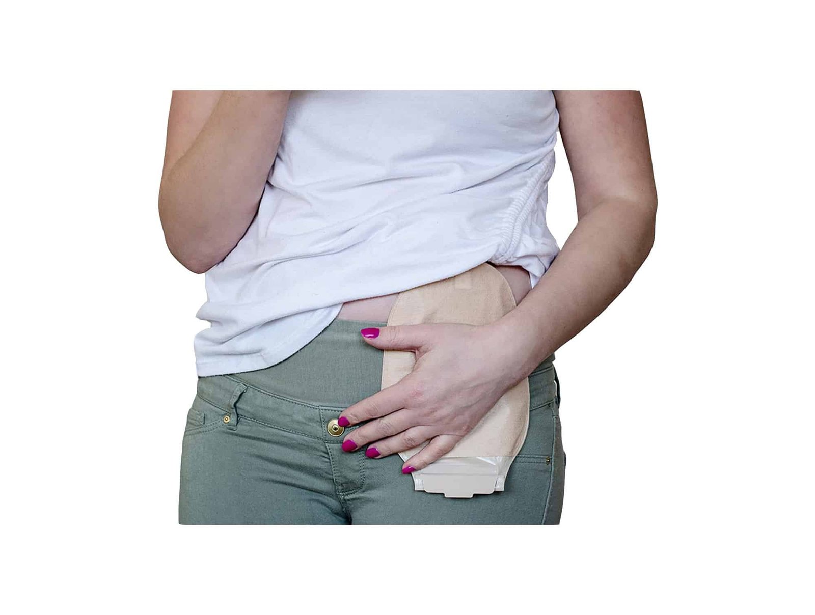 Poche d’iléostomie Alterna ( Système 1 pièce )