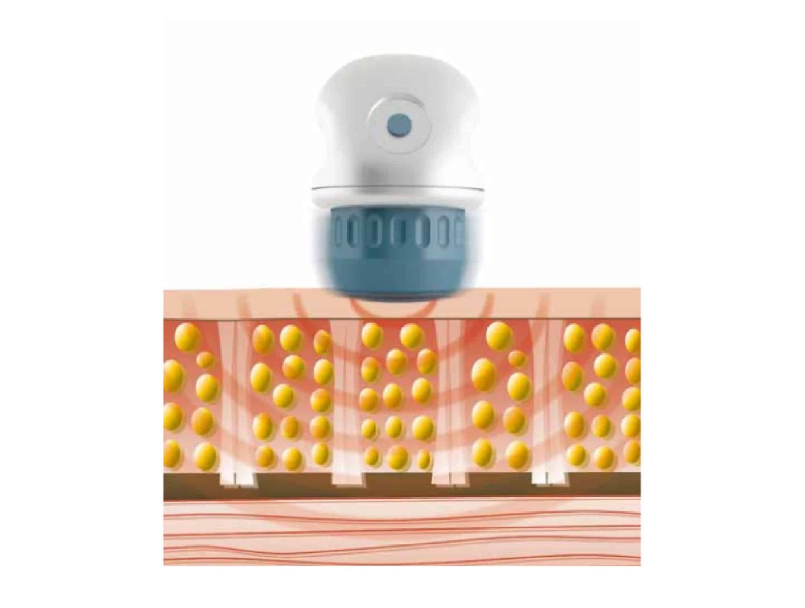 Applicateur V-ACTOR pour Intelect