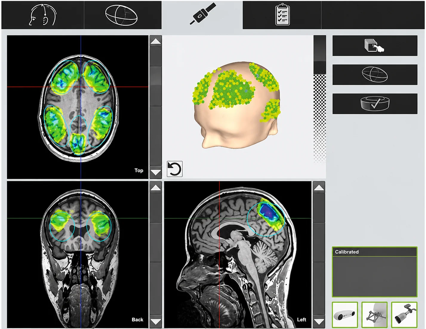 Stimulation transcrânienne par impulsions (TPS)
