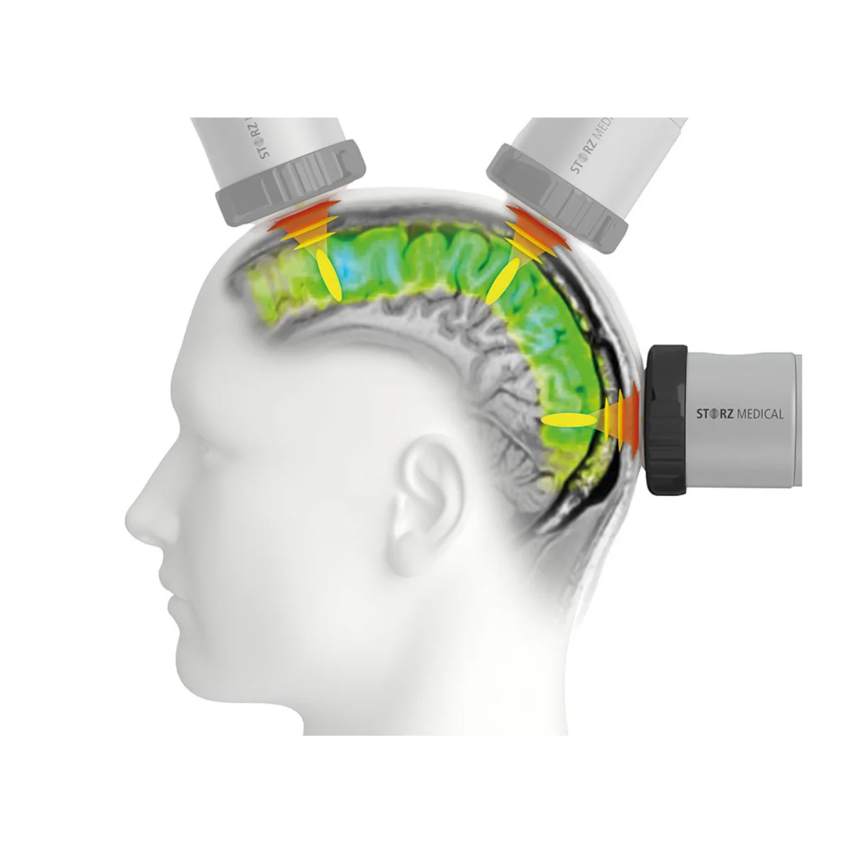 Stimulation transcrânienne par impulsions (TPS)