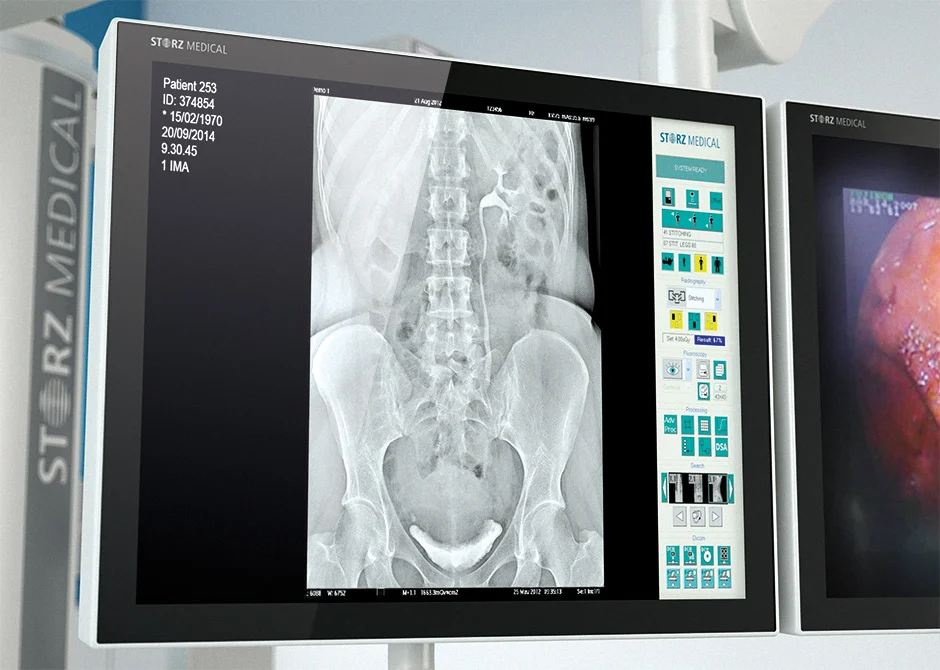 Plateforme urologique avec lithotritie ESWL intégrée